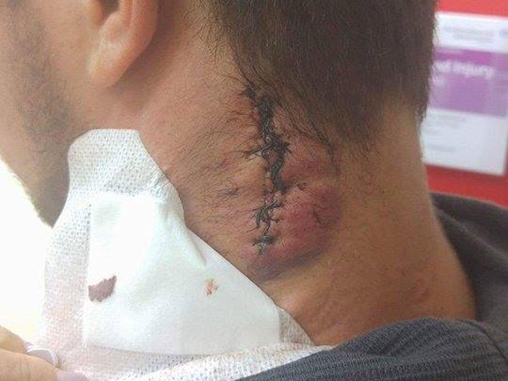 Bartosz Milewski needed 13 stitches after being stabbed in the neck