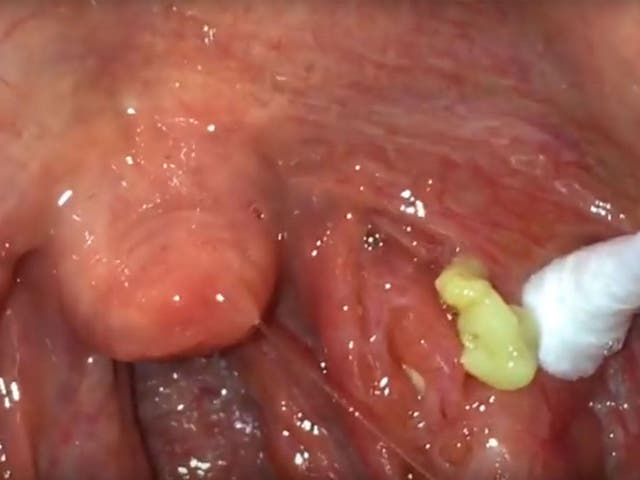 YouTube user Tonsil Stone Man films the removal of a tonsilloliths.