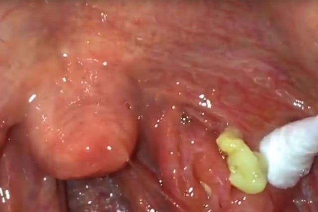 YouTube user Tonsil Stone Man films the removal of a tonsilloliths.