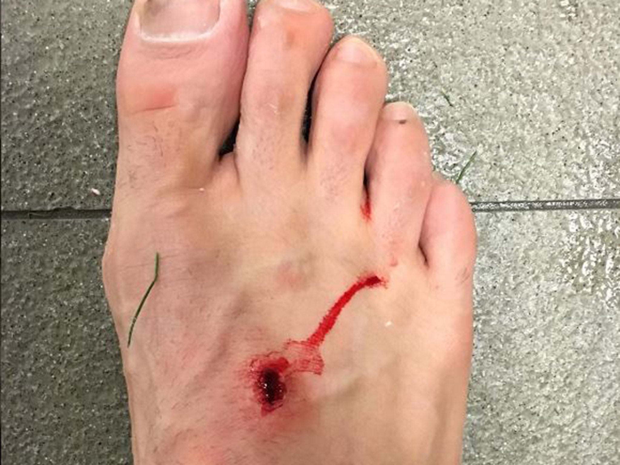 Filipe Luis revealed the gruesome injury on Instagram