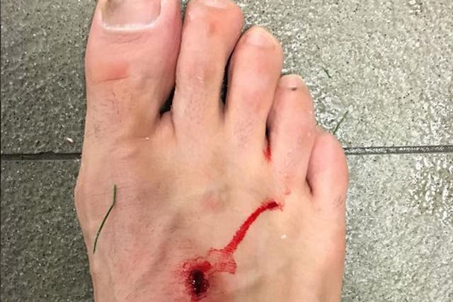 Filipe Luis revealed the gruesome injury on Instagram
