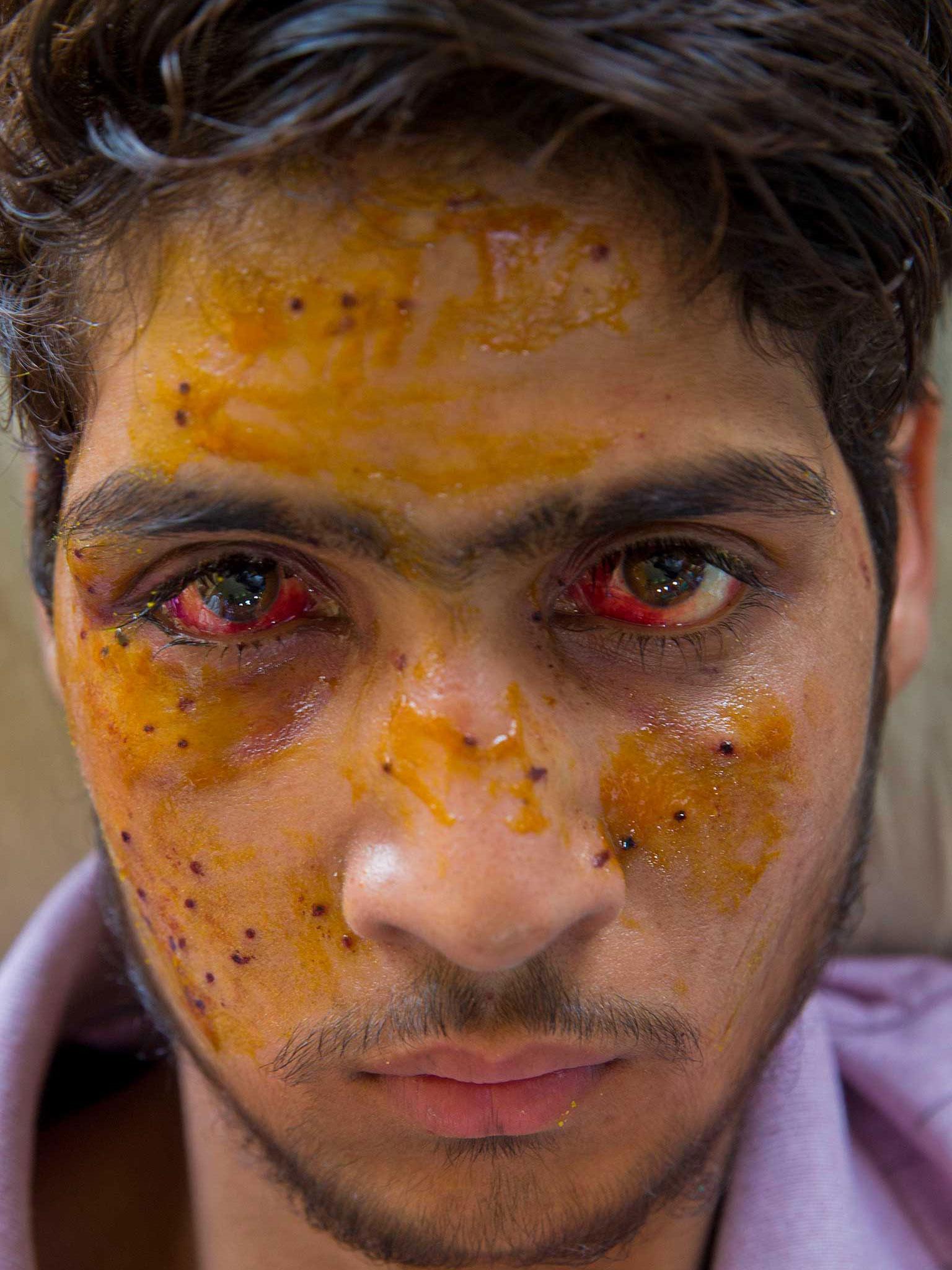 Mohammad Imran Parray, who got wounded after being hit by pellets during a protest recovers at a hospital in Srinagar, Indian controlled Kashmir