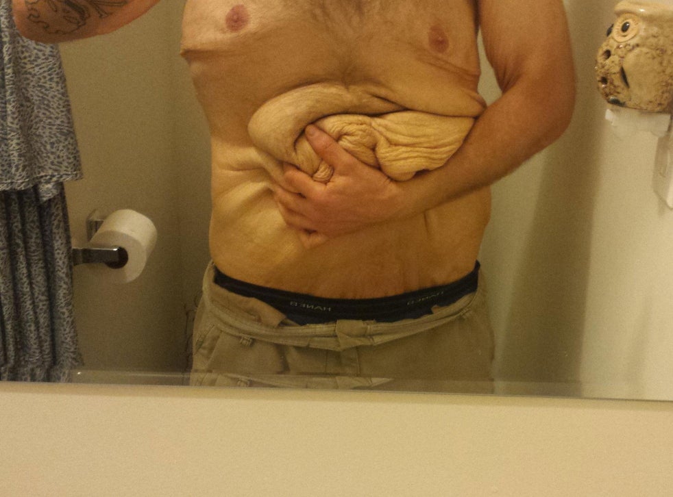 Man Loses Weight Of Two People After Mistaking Chest Pain For Heart Attack But Keeps Excess Skin The Independent The Independent