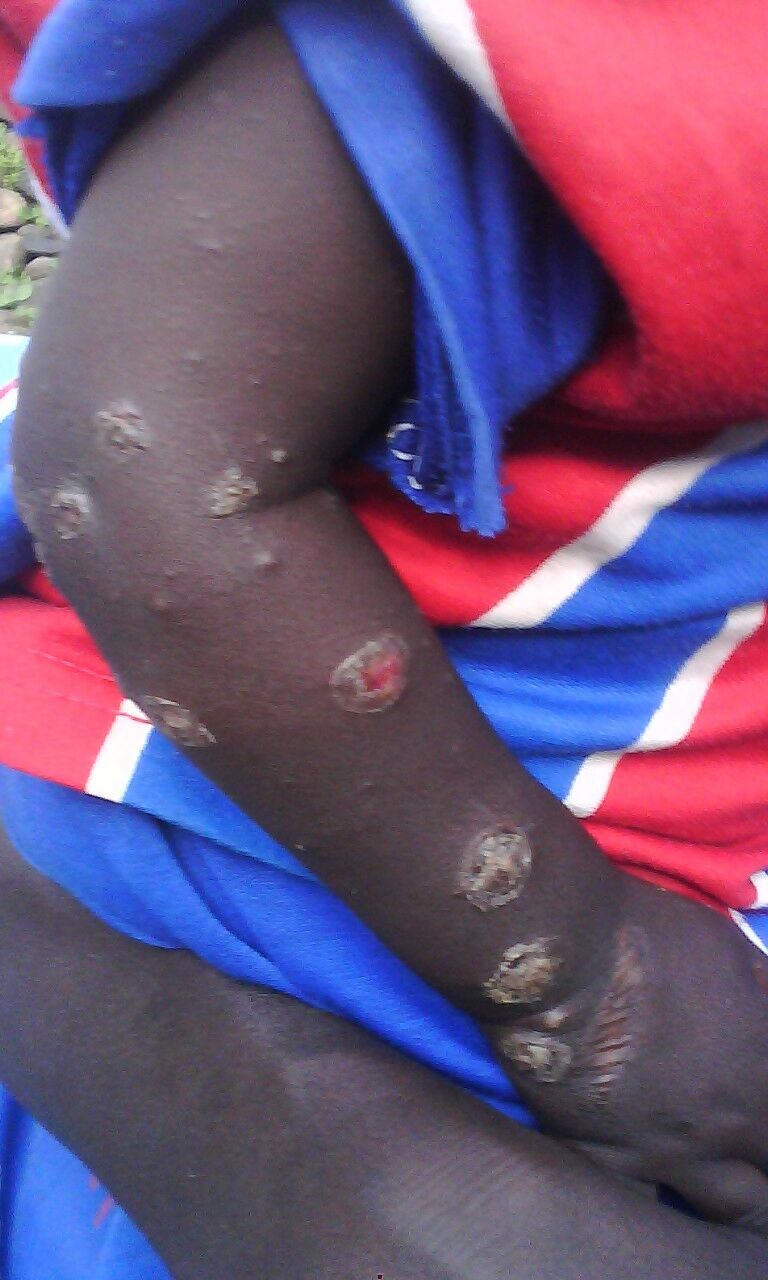 This child's right arm shows large roughly circular lesions showing apparent scarring