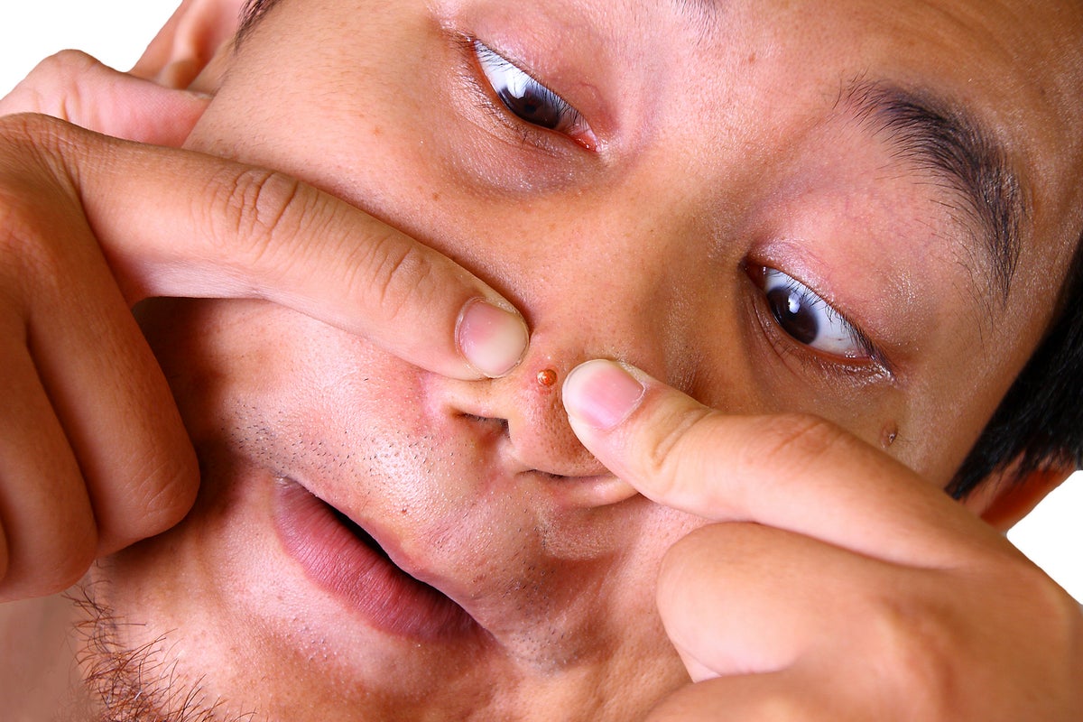 How squeezing a spot on your nose could land you in hospital 