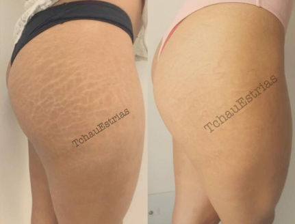 INKED Guide to Tattooing Over Stretch Marks