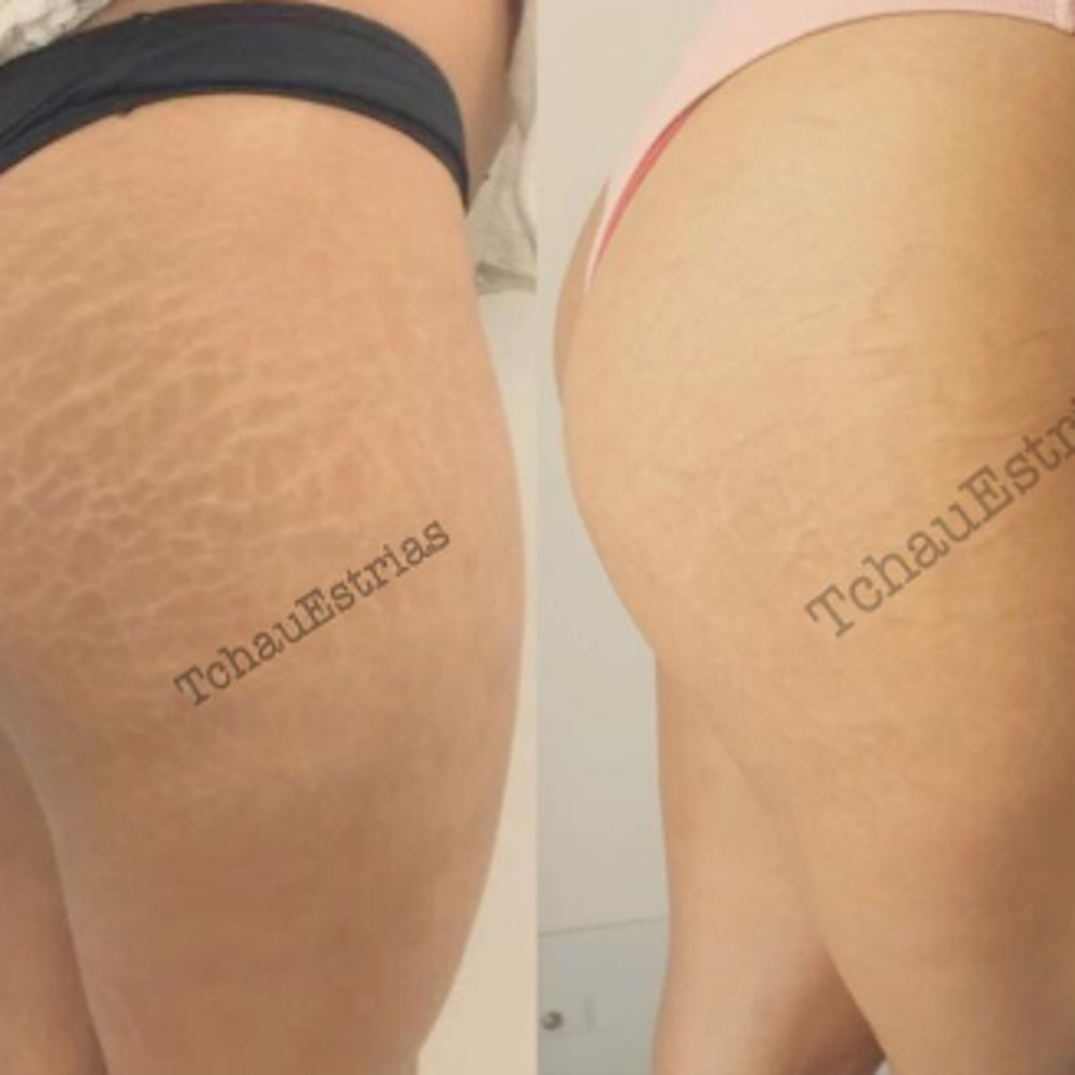 Tattoo Artist Turns Stretch Marks Into Art