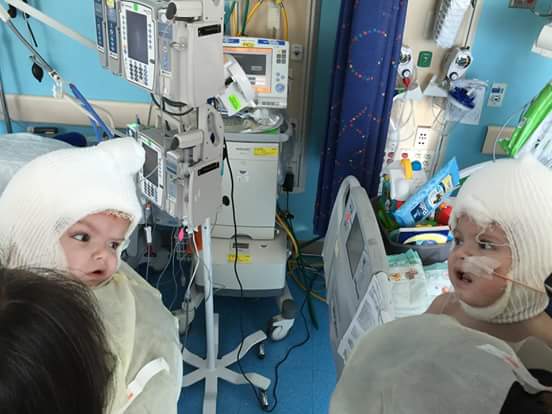 Conjoined twins Jadon and Anias look at each other for the first time after surgery