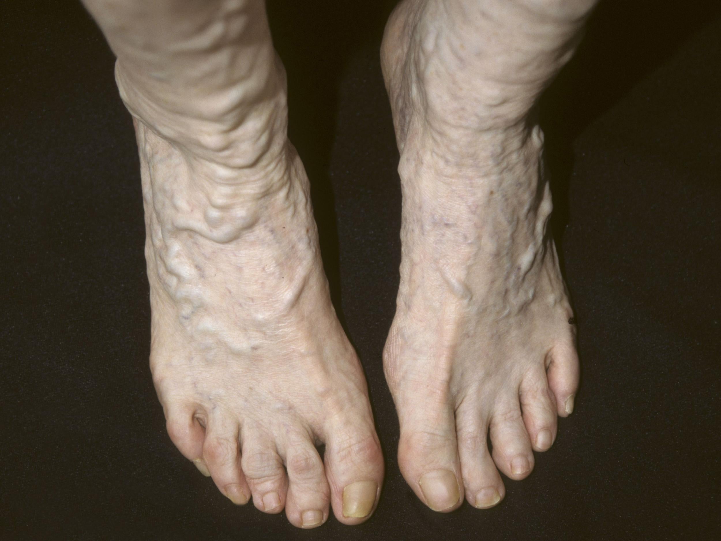 Varicose veins are a problem commonly associated with old age (Rex)