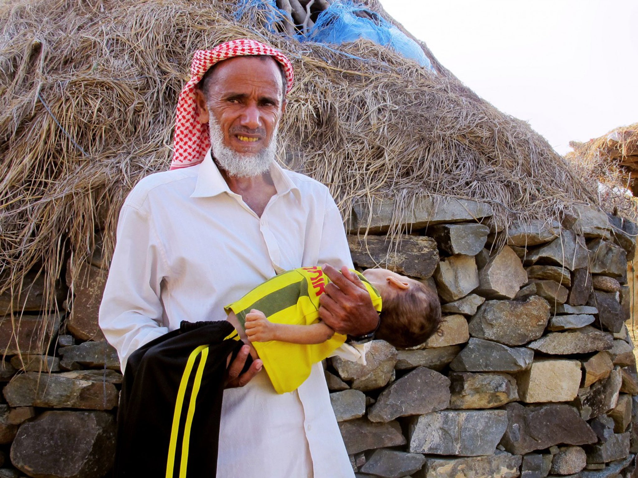 Ahmed Sadek carries his two-year-old grandson, Osama Hassan, in the mountainous area of Bani Saifan, where their village is located. Osama is suffering from severe malnutrition, but his family cannot afford to send him to a hospital