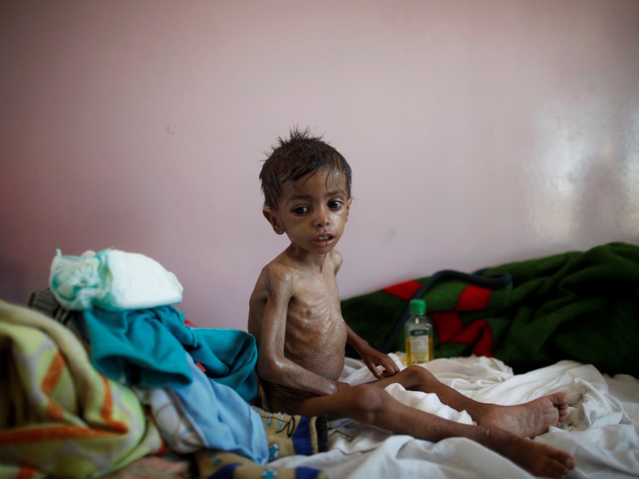 A malnourished boy sits on a bed at a malnutrition treatment center in Sanaa, Yemen, on October 30 2016