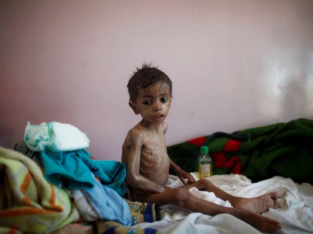 More than 370,000 children are at risk of starvation in Yemen alone