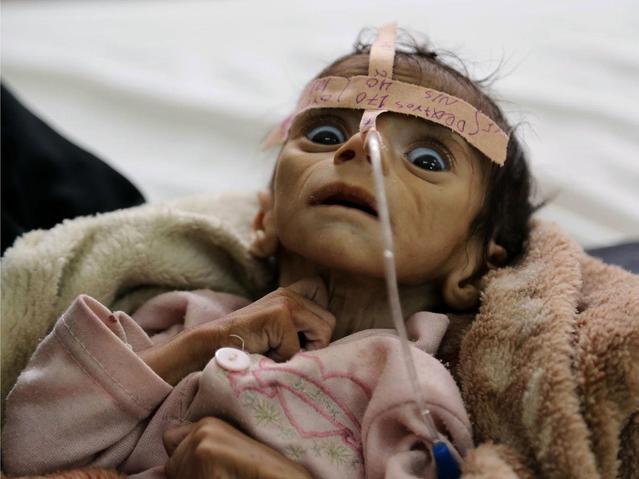 Udai Faisal, an infant suffering from acute malnutrition, at Al-Sabeen Hospital in Sanaa, Yemen, on 22 March, 2016. Udai died on 24 March