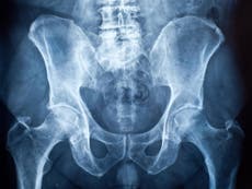 Scientists discover why humans have no penis bone