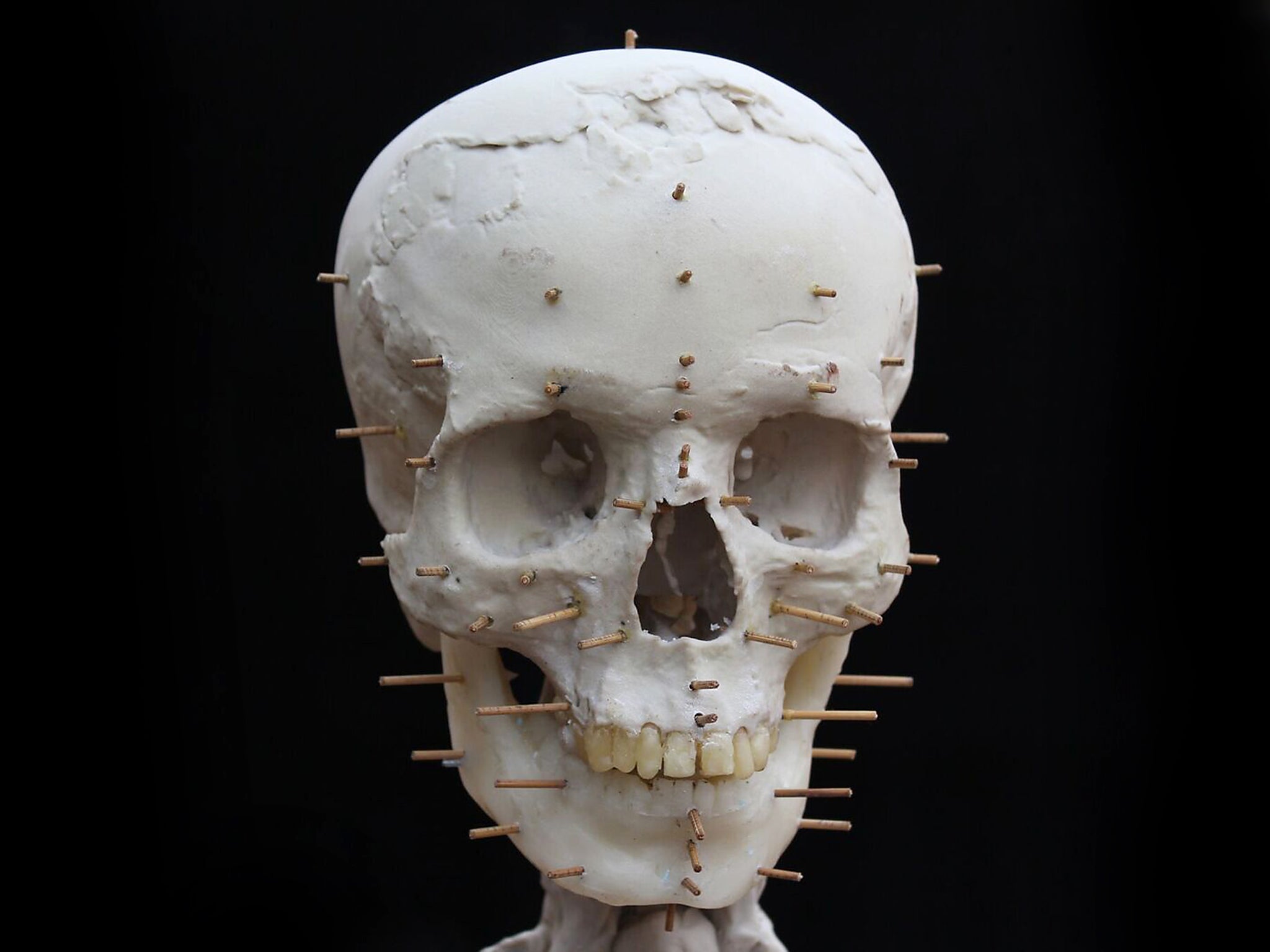 The early stages of facial reconstruction. Pegs are used to gauge tissue depth