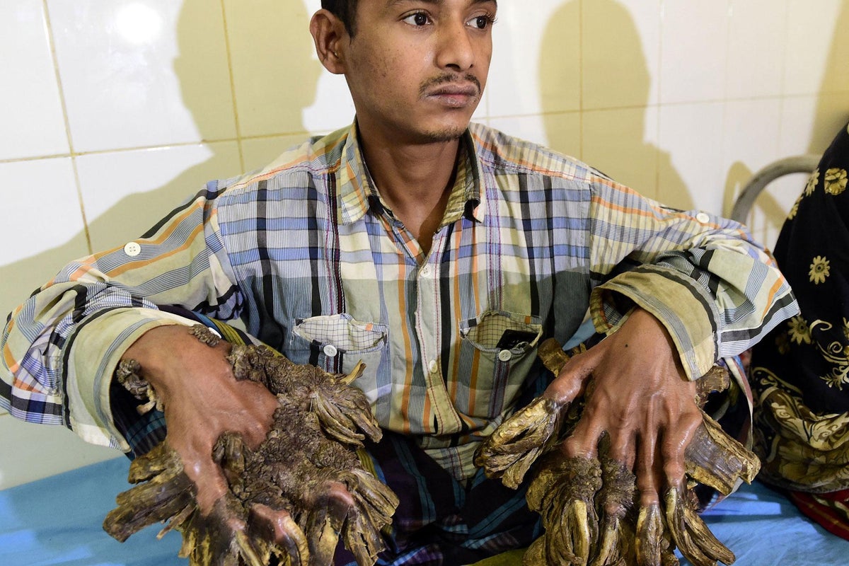 Tree man' of Bangladesh 'cured' after 16 operations to fight rare skin condition, potentially making medical history | The Independent | The Independent