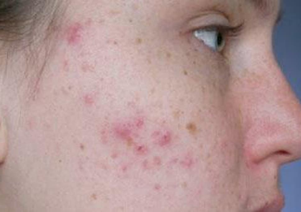 Roaccutane: How controversial acne wonder-drug linked to suicide ...
