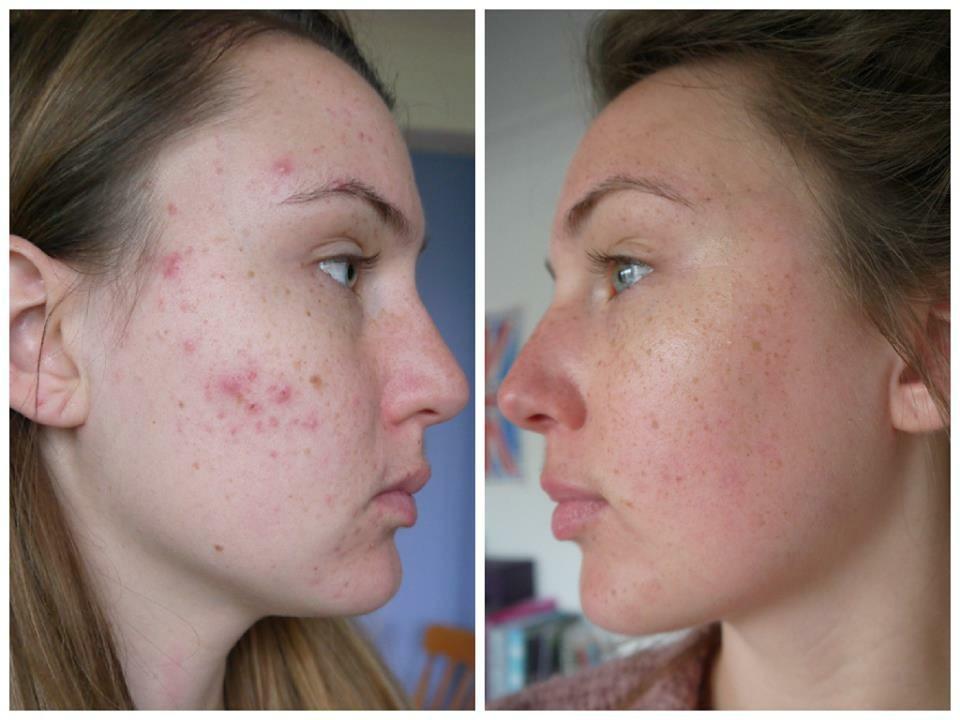 Rachel before taking isotetrinoin, and five months later