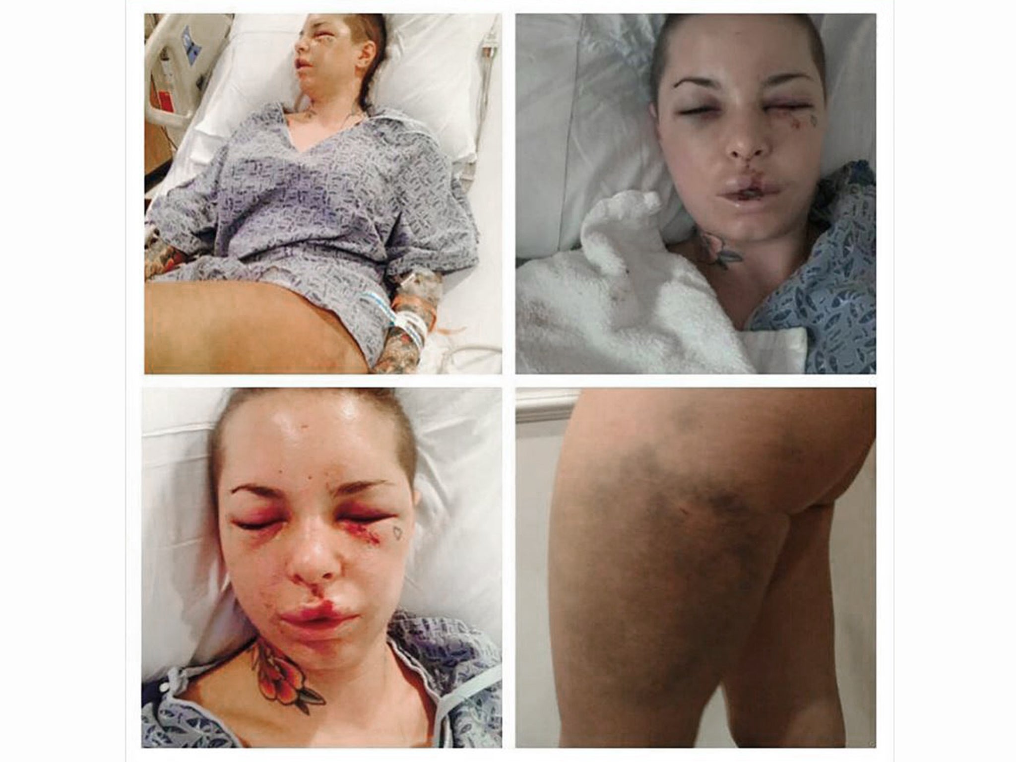 Christy Mack's injuries