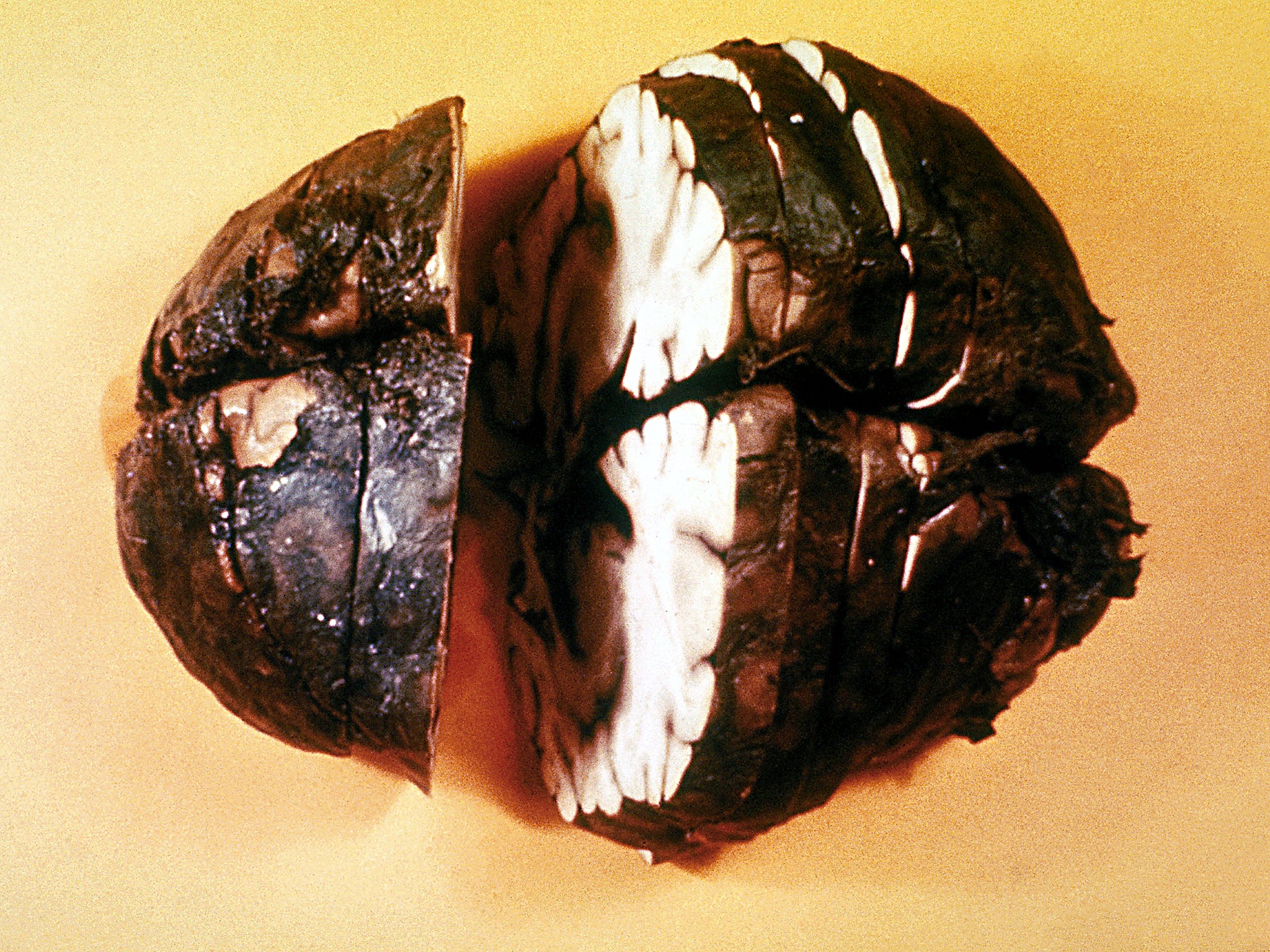 A brain specimen shows haemorrhagic meningitis caused by inhaling anthrax