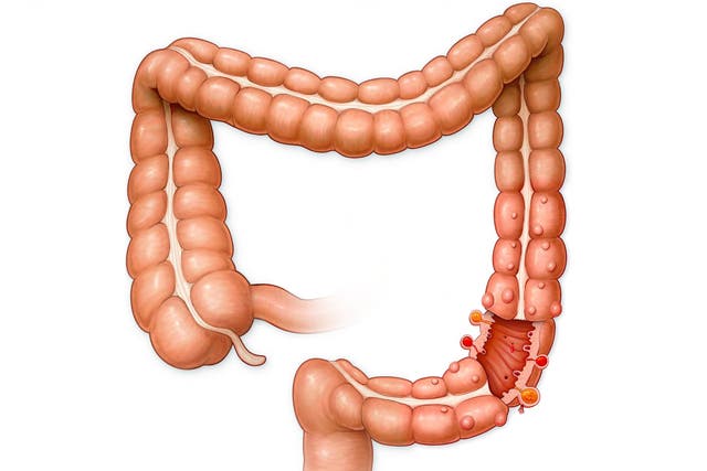 A diagram of the large intestine with the appendix visible on the left hand side