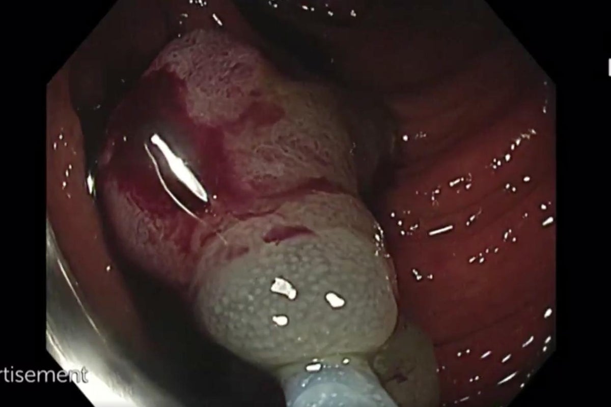 Channel 4 broadcast live colonoscopy as part of bowel cancer campaign ...