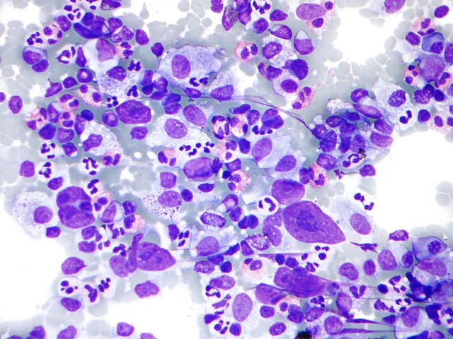 Hodgkin’s lymphoma cells: survival rates this blood disease and many other cancers have improved massively over the years