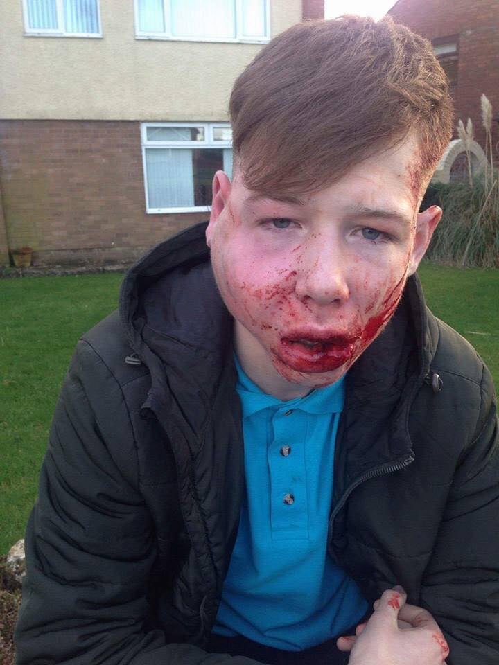 The 15-year-old was left bloodied and with huge swelling to the right side of his face after the assault on his way home from school in Bridgend