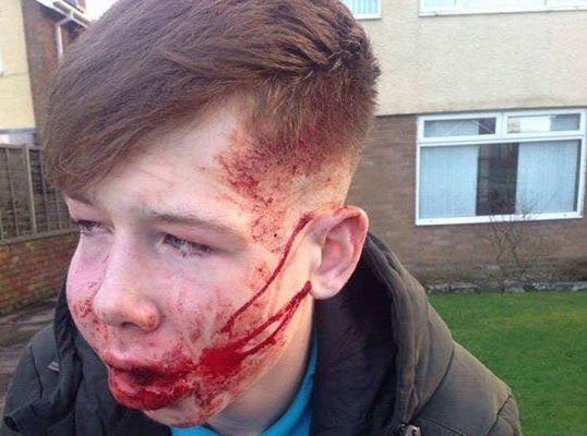 The 15-year-old boy was taken to hospital with a suspected broken jaw following the attack