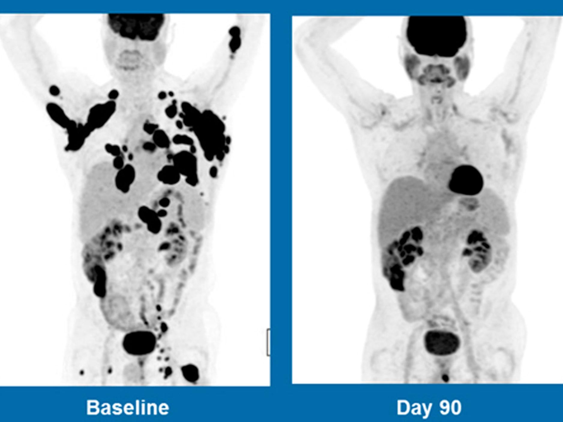 These scans show a 62-year-old man with non-Hodgkin lymphoma. The picture on the left was taken in in December 2015, the one on the right three months after treatment with an experimental gene therapy at the Anderson Cancer Centre in Houston