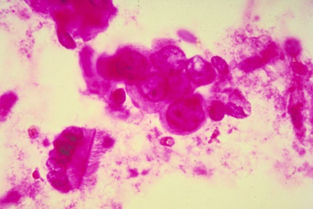 Breast cancer cells under the microscope