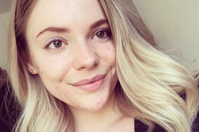 Rachel Crawley has struggled with acne since she was a teenager