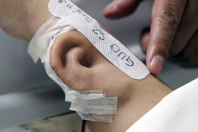 The patient's new ear was grown on the side of his arm
