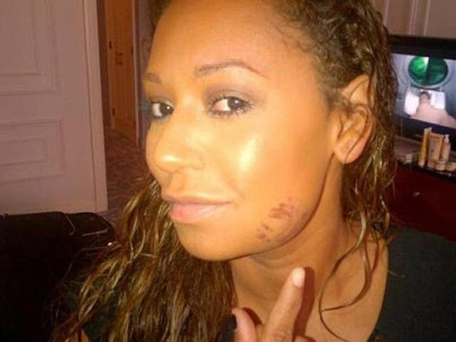 Melanie Brown displays a bruise on her cheek in a Twitter post from 2012. At the time she claimed to have suffered the injury after tripping over on holiday in Prague