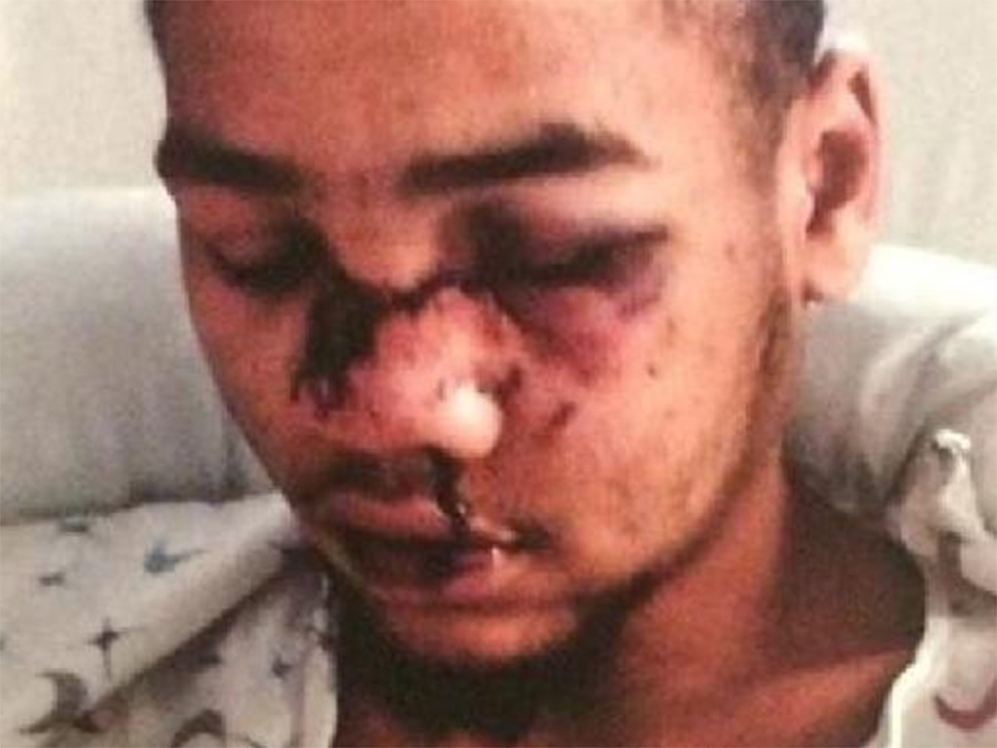 Tyran Dobbs suffered broken facial bones, a fractured rib and bruised lungs after being shot with rubber bullets by police