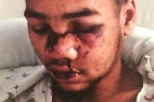 Tyran Dobbs suffered broken facial bones, a fractured rib and bruised lungs after being shot with rubber bullets by police