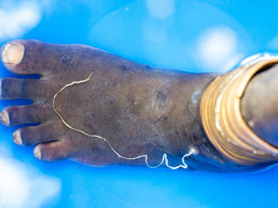 A patient's foot with the Guinea worm. The most immediate impact of new funding would be to 'wipe out' the parasite