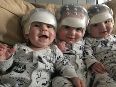 Triplet babies make medical history after all braving rare surgery