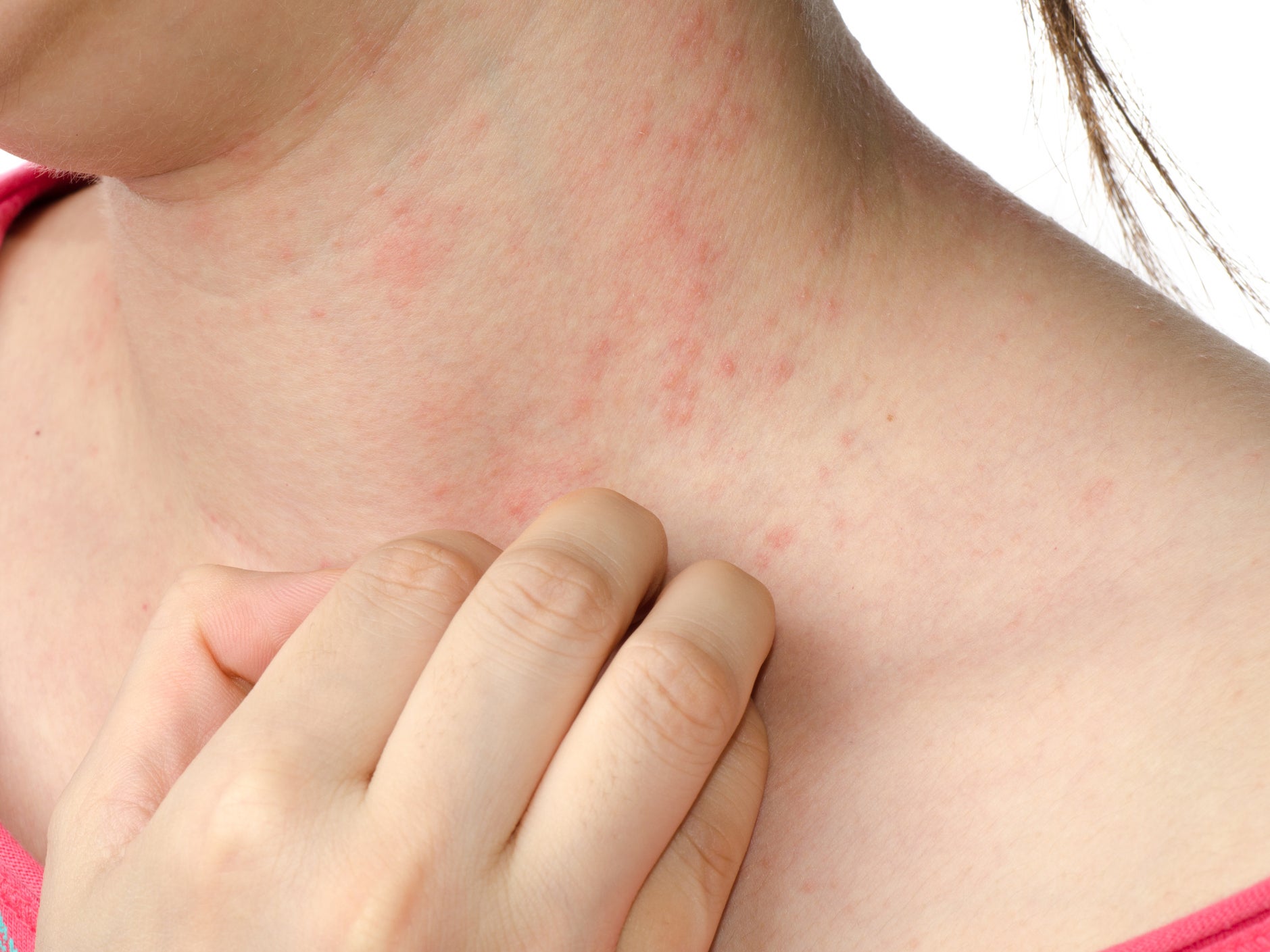 how do you cure eczema