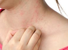 Eczema cure a step closer as scientists discover what triggers painful skin condition