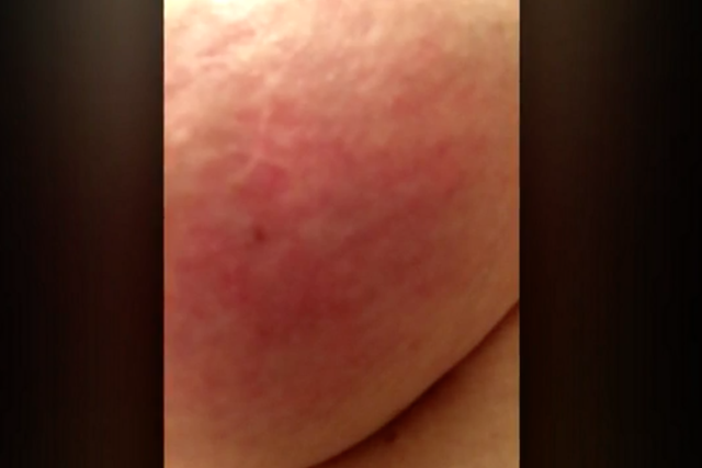 Rare Breast Cancer Disguised As A Rash Is Delaying Diagnosis The Independent The Independent