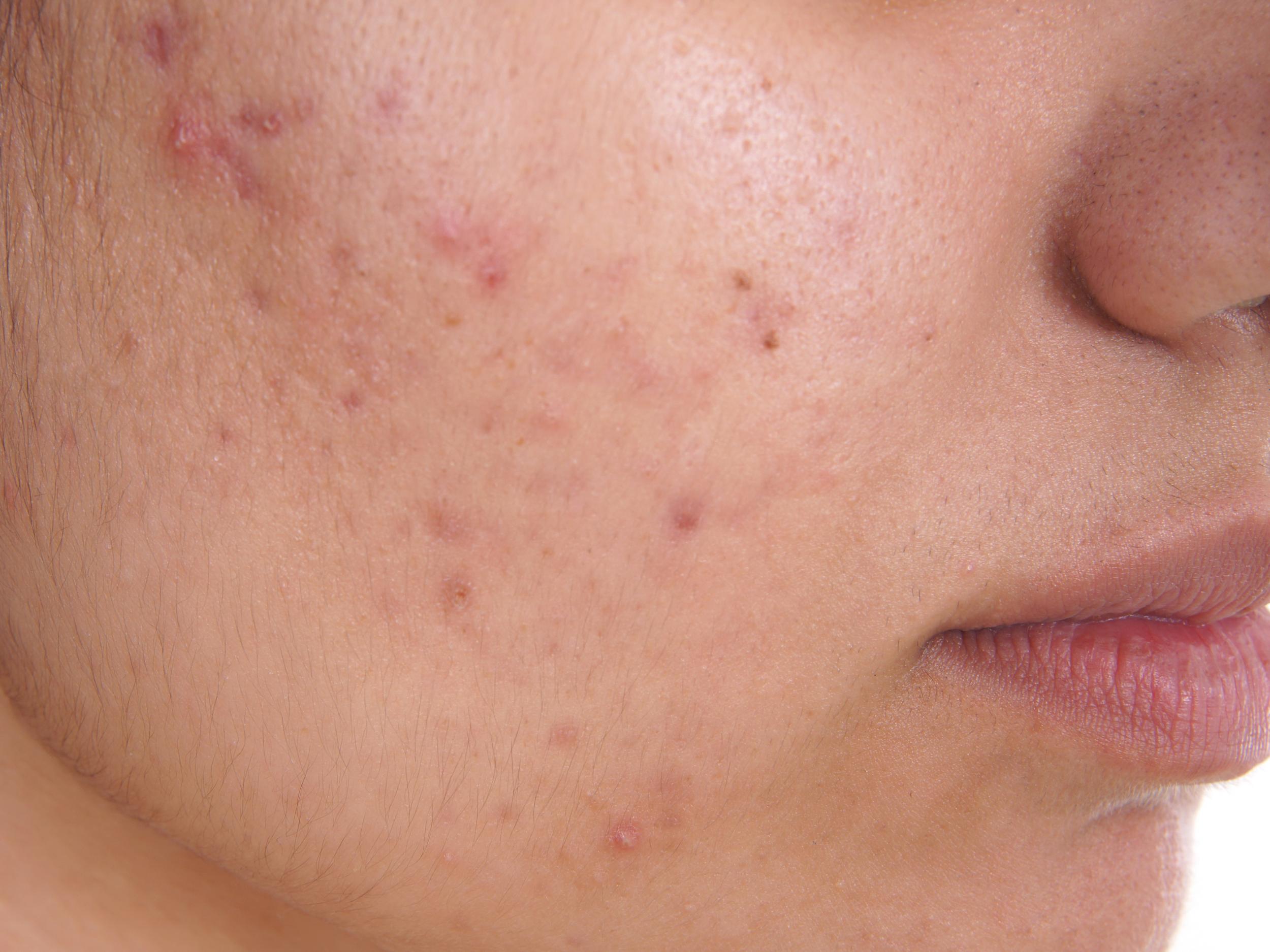 Acne is a very common skin condition that usually starts during puberty