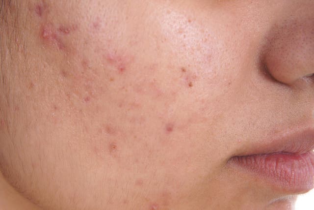 Acne is a very common skin condition that usually starts during puberty
