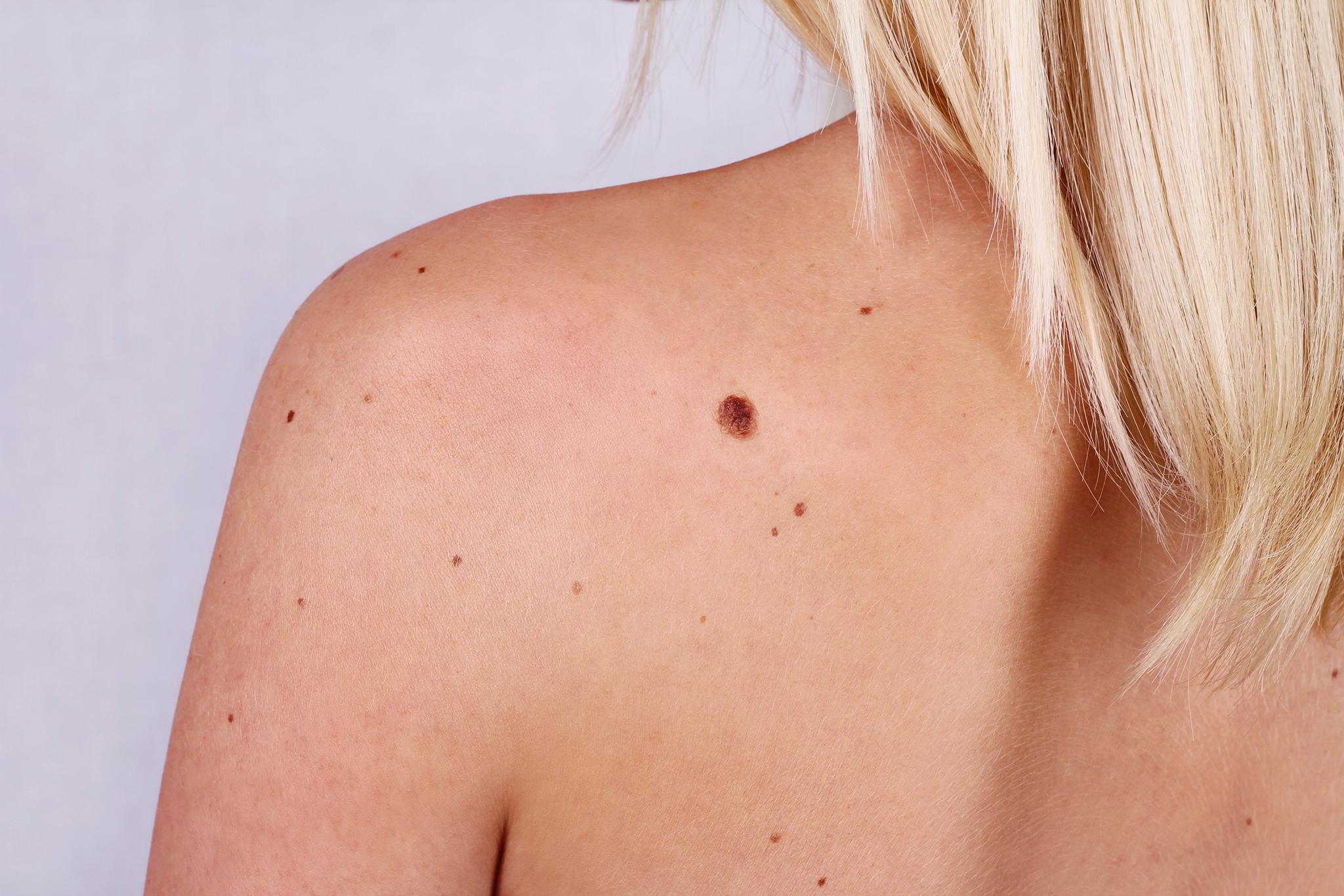 large cancerous skin tags pictures