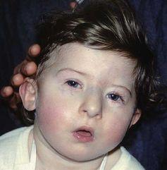 A child with 22q11.2 deletion syndrome