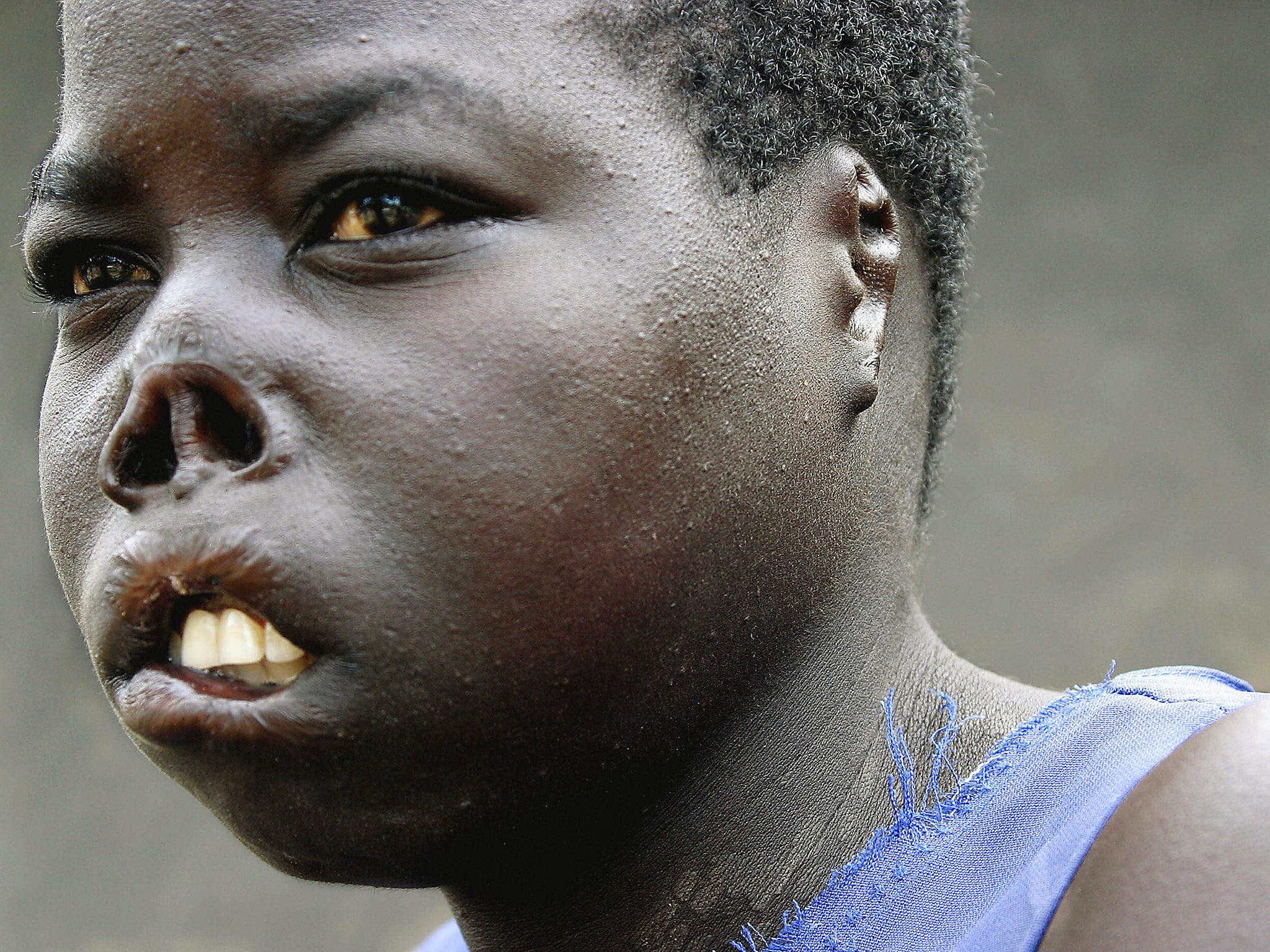Auma Consolata was abducted by the LRA – who cut off her lips, ears and nose – in 2005, aged 17 (Getty)