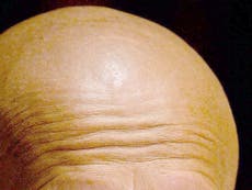 New cause of baldness accidentally discovered by scientists