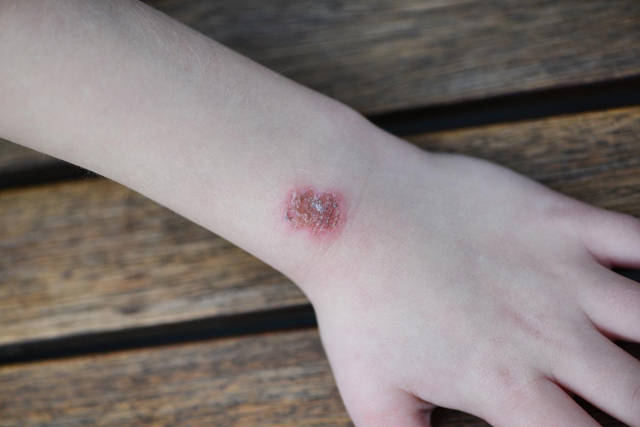 Children are burning their own arms repeatedly using an aerosol deodorant