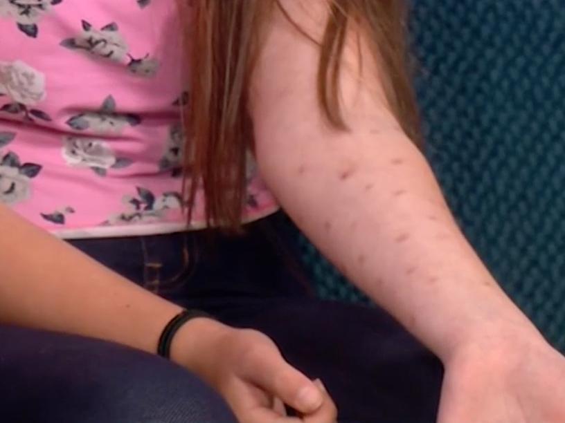Kaitlyn told ITV that she "didn't know" how she felt about the way her arm looks now