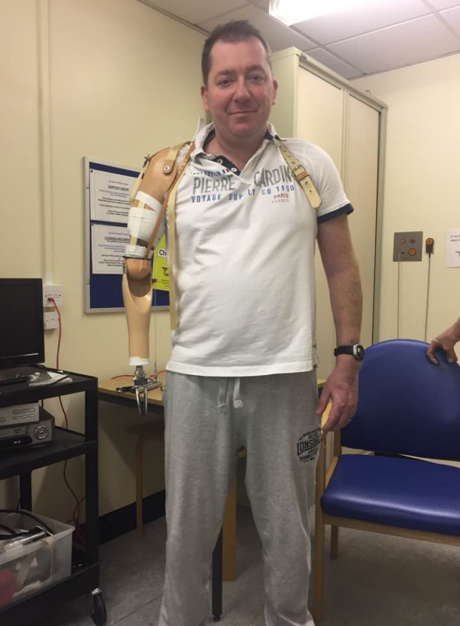 
Mr Cole underwent six operations to fight the infection, including the amputation of his right arm 